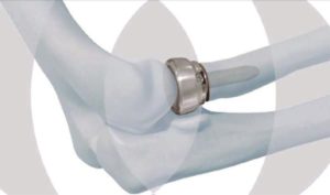 DePuy Synthes Radial Head Prosthesis System